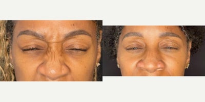 Bunny Line Treatment - Treating bunny lines using neuromodulator (Botox/Dysport)