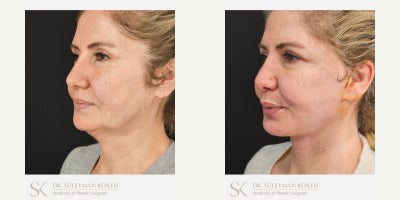 45-54 year old woman treated with Deep Plane Facelift, Chin Liposuction, Facial Fat Transfer - Deep plane full face and neck liftChin LiposuctionNasolabial fat transfer