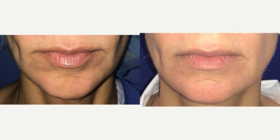 45-54 year old woman treated with Chin Implant - Patient is 6 months post op her chin implant