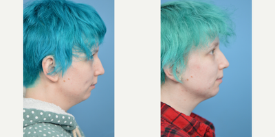 25-34 year old woman treated with Kybella - 26 year old concerned with the fullness under her chin. The result shown is after one Kybella treatment.