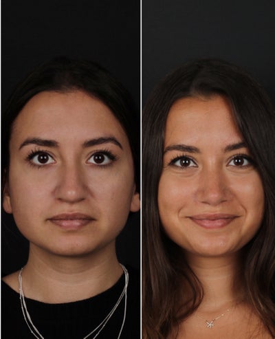 Woman treated with Rhinoplasty - Woman treated with Rhinoplasty