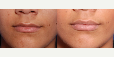 25-34 year old woman treated with Juvederm to the lips - Juvederm filler applied to lips for lip augmentation
