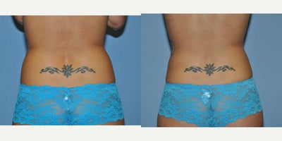 25-34 year old woman treated with Liposuction - Liposuction to the Hip Rolls