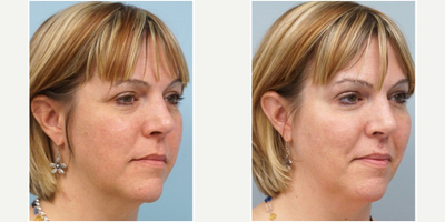 45-54 year old woman treated with Voluma - Voluma, a hyaluronic acid filler designed for cheek augmentation is carefully injected to volumize her midface region. She appears younger with restoration of the apples and enhancement of the Ogee curve.
