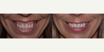 35-44 year old woman with Gummy Smile treated with Botox - Before and after 10 units of Botox for a gummy smile