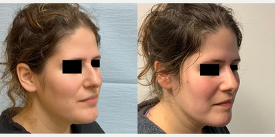 Woman treated with Rhinoplasty - Rhinoplasty