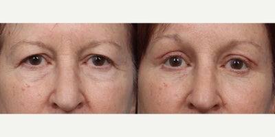 55-64 year old woman treated with Brow Lift, Eyelid Surgery - Patient had an endoscopic browlift with an upper and lower eyelid blepharoplasty.