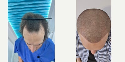 2534 year old man treated with DHI Hair Transplant - The patient underwent a DHI hair transplant procedure performed entirely by a physician. The treatment was planned individually, including hairline design and graft distribution, based on donor capacity and facial proportions.This case presents the early healing stage at 1 month post-op. At this stage, the transplanted area is fully healed, with visible early regrowth and correct graft placement. Final density and cosmetic results are expected to continue improving over the next several months.The DHI technique was chosen to allow precise control of graft angle, direction, and depth, while minimizing trauma to the scalp and supporting natural-looking results.The patient is under regular post-operative follow-up, and the outcome will continue to evolve as part of the normal hair growth cycle.