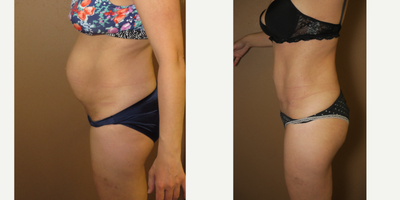 35-44 year old woman treated with Tummy Tuck - abdominoplasty