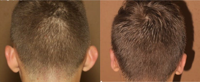 Man treated with Ear Surgery - Man treated with Ear Surgery