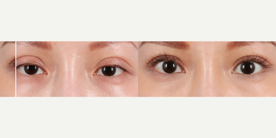 Woman treated with Ptosis Surgery - his beauty became completely transformed after we were able to successfully perform a revision Upper Blepharoplasty & Ptosis repair. Photos shown above are 6 months post-op