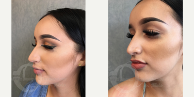 18-24 year old woman treated with Lip Augmentation - lip injections