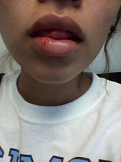My Lips Split Open Sort Of Deep And Like One Side Of M