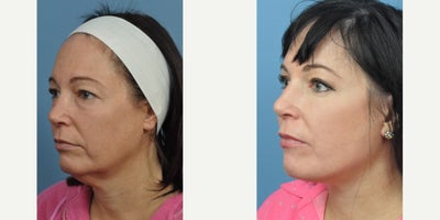 45-54 year old woman treated with Mini Lift - Patient whom had a Minilift and Eyelid surgery. Also had conservative amount of fat to the cheeks and tear troughs.