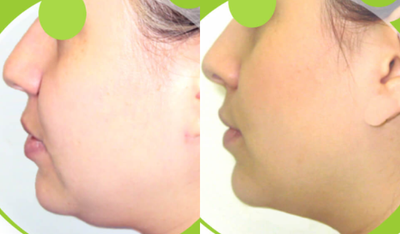 18-24 year old woman treated with Cheek Lift - 18-24 year old woman treated with Cheek Lift