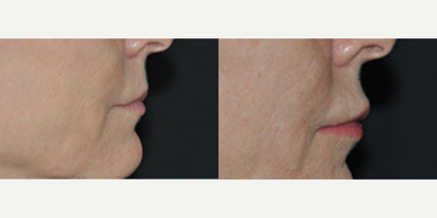55-64 year old woman treated with Lip Implants - Permanent Lip Augmentation 55 years old5mm Perma Facial implants upper and lower