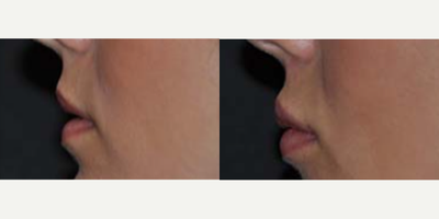 25-34 year old woman treated with Lip Implants - Permanent Lip Augmentation - 28 years old5mm Perma Facial implants upper and lower