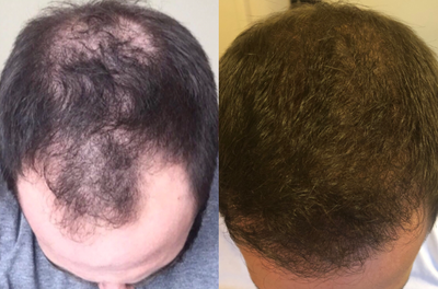 35-44 year old man treated with ARTAS Robotic Hair Transplant - 2700 grafts