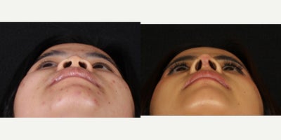 25-34 year old woman treated with Rhinoplasty, Asian Rhinoplasty - 3 weeks after rhinoplasty with rib graft for our beautiful patient! She is recovering so well and we could not wait any longer to get her photos out there. We borrowed her rib and deeper soft tissue to create a bridge with an onlay graft and project her tip with the extra cartilage. We still have more swelling we expect to resolve with more time, especially above her tip and we can't wait for it to continue to narrow. Thanks to her for allowing us to share!