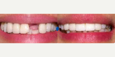 35-44 year old woman treated with Smile Makeover - 40 year-old woman lost her front tooth in a car accident. She also chipped her other front tooth. Dr. Steven Davidowitz inserted an esthetically positioned dental implant to replace her lost tooth. Both front teeth were restored to their natural beauty with Porcelain crowns