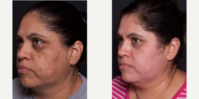 45-54 year old woman treated with Chemical Peel - Patient came in wanting to correct her uneven pigmentation. After consulting with our aesthetician, she elected to have the Melanage Mask Peel.