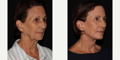 55-64 year old woman treated with Facelift, Eyelid Surgery, Laser Resurfacing, Facial Fat Transfer - MD Restore, Deep-Plane (Additional Procedures: Eyelids, Laser Resurfacing, Fat Transfer)