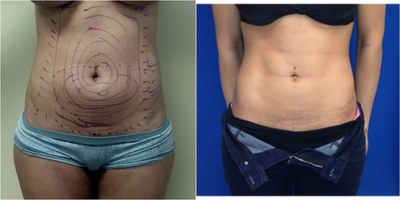 Laser Liposuction -
Laser Liposuction