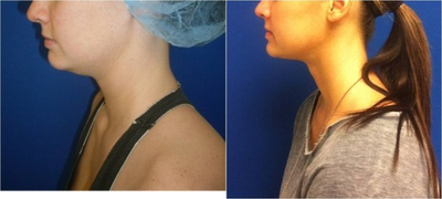 Laser Liposuction -
Laser Liposuction