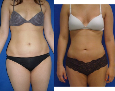 Laser Liposuction -
Laser Liposuction