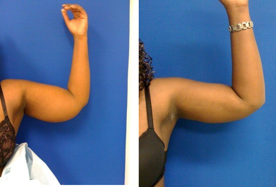 Laser Liposuction -
Laser Liposuction