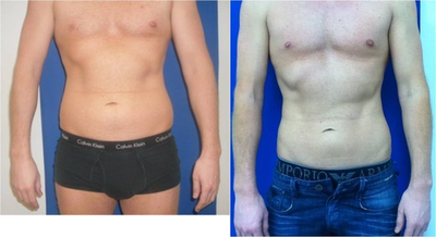 Laser Liposuction -
Laser Liposuction