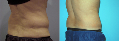 55-64 year old man treated with CoolSculpting - CoolSculpting procedure