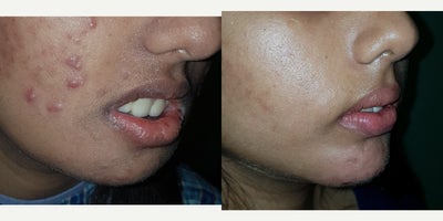 25-34 year old woman treated with Botox for Gummy Smile - 26 year old who had oral incompetence treated with botulinum toxin and had acne treatment