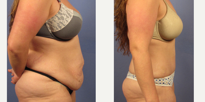 35-44 year old woman treated with Tummy Tuck - Dr. Bryson Richards performed a tummy tuck on this very active female. 