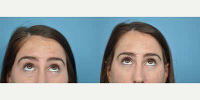 25-34 year old woman treated with Vollure - 29 year old concerned with hollowness under the eyes. Patient was injected with Vollure using a catheter to achieve a more rejuvenated appearance.