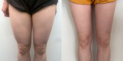 25-34 year old woman treated with Lipodissolve, BodyTite - Fat-dissolving injections to contour the thighs