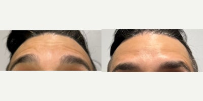 35-44 year old man treated with Botox - Horizontal Forehead Lines treated with 14 units of Botox