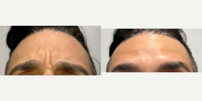 35-44 year old man treated with Botox - Glabellar Lines treated with 20 units of Botox