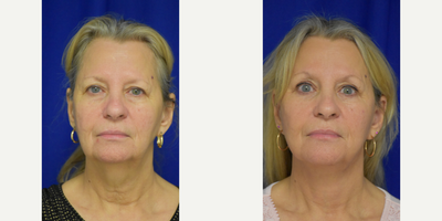 2926 65-74 year old woman treated with Facelift, Chin Liposuction, Double Eyelid Surgery, Brow Lift - 45-54 year old woman treated with Facelift, Neck Lift, Facial Fat Transfer, Eyelid Surgery