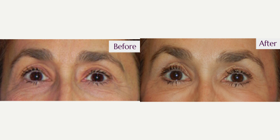 55-64 year old woman treated with Thermage - Before and After Thermage for skin tightening! This patient treated her upper and lower eye lids as well as her forehead to achieve these results!