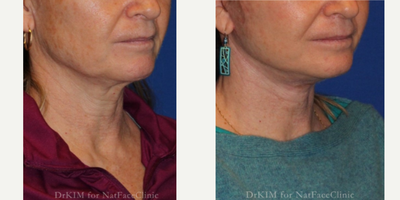 55-64 year old woman treated with Facelift, Chin Liposuction, CO2 Laser, Lip Lift - This patient had a facelift, submental liposuction, eCO2 laser to her bilateral periorbital areas and SMAS to her upper and lower lips.