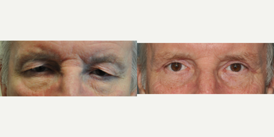 65-74 year old man treated with Eyelid Surgery - This patient had an upper eyelid Blepharoplasty.