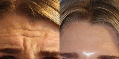 First time Dysport user - First time injectable patient.