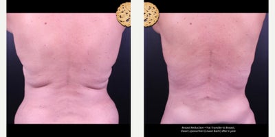 55-64 year old woman treated with Breast Reduction, Breast Fat Transfer, Vaser Liposuction - Breast Reduction + Fat Transfer to Breast, Vaser Liposuction (Lower Back) after 1 year