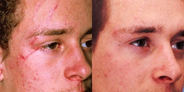 Scars Treatment