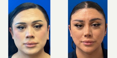 25-34 year old transgender woman treated with Facial Feminization Surgery - Facial Feminization