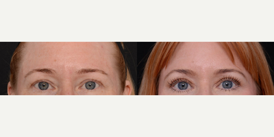 Woman treated with Brow Lift - Are you searching for a way to do away with sagging brows and replace it with a smoother, wrinkle-free forehead? Its time to ditch droopy eyebrows! A Brow Lift is a fantastic solution to refresh your face for those who are looking for results that last longer than Botox. Dr.Ho is a double board certified facial plastic surgeon who uses the latest techniques to allow this procedure to be completed in a relatively short period of time on an outpatient basis.