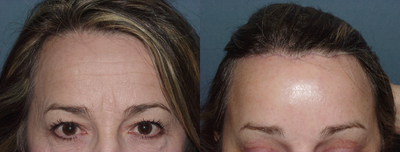 Browlift/forehead reduction at 2 weeks - This patient is 2 weeks after a trichophytic browlift. The effect is to not only raise the brows, but lower the hairline. It is best used in someone who has a large forehead. This incision heals well eventually, but may take some time to fade.