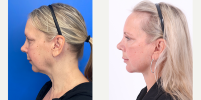 55-64 year old woman treated with Facelift, Neck Lift, Eyelid Surgery, Facial Fat Transfer - 57 year old 1 year after Facelift, Neck lift, Upper Eyelid Blepharoplasty and Facial Fat transfer with Dr. Madnani