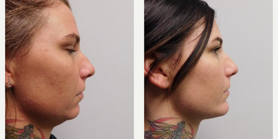 Woman treated with Chin Implant - After a chin augmentation, liposuction of submental area (also known as double chin removal), and renuvion, its easy to see that this patients surgeries enhanced the overall look of her face. 4 months post-op.